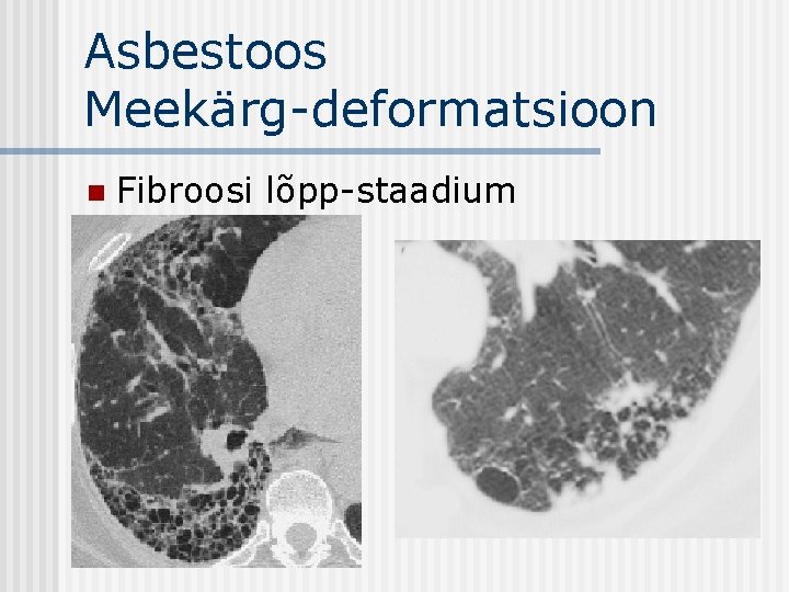 Asbestoos Meekärg-deformatsioon n Fibroosi lõpp-staadium 