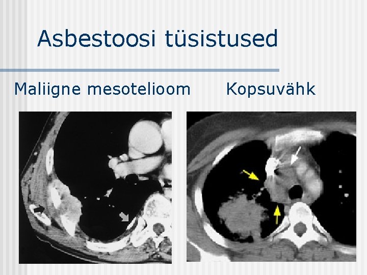 Asbestoosi tüsistused Maliigne mesotelioom Kopsuvähk 