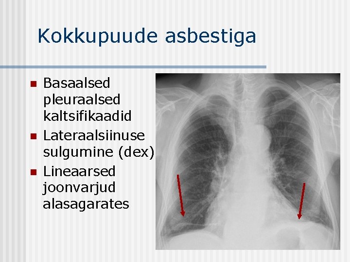 Kokkupuude asbestiga n n n Basaalsed pleuraalsed kaltsifikaadid Lateraalsiinuse sulgumine (dex) Lineaarsed joonvarjud alasagarates