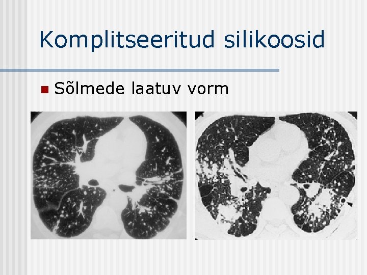 Komplitseeritud silikoosid n Sõlmede laatuv vorm 