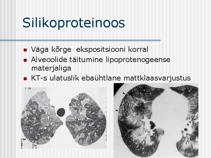 Silikoproteinoos n n n Väga kõrge ekspositsiooni korral Alveoolide täitumine lipoprotenogeense materjaliga KT-s ulatuslik