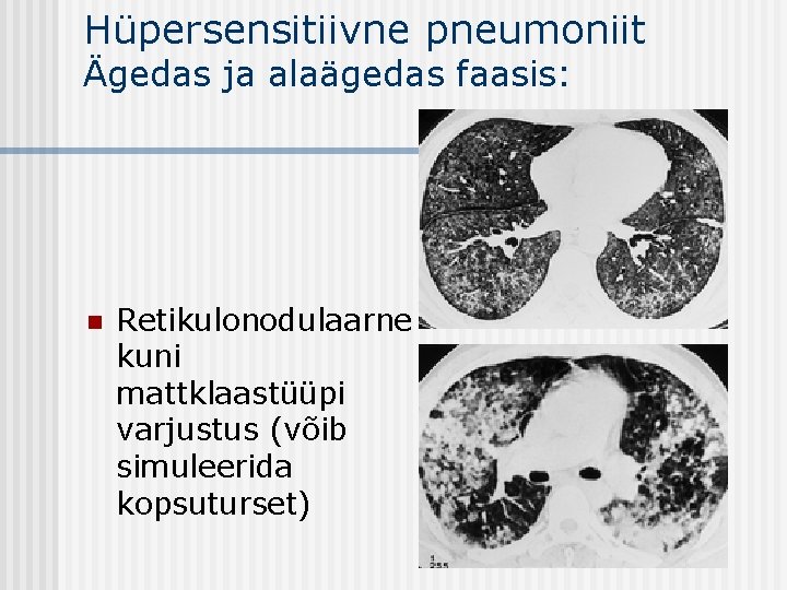 Hüpersensitiivne pneumoniit Ägedas ja alaägedas faasis: n Retikulonodulaarne kuni mattklaastüüpi varjustus (võib simuleerida kopsuturset)