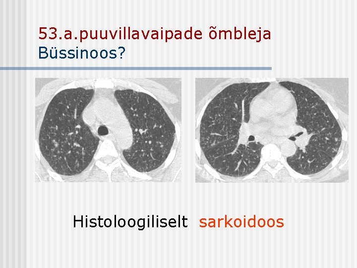 53. a. puuvillavaipade õmbleja Büssinoos? Histoloogiliselt sarkoidoos 