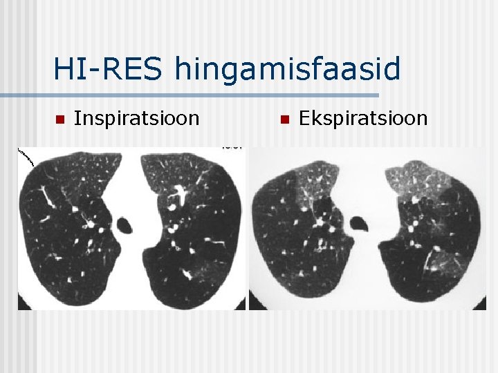 HI-RES hingamisfaasid n Inspiratsioon n Ekspiratsioon 