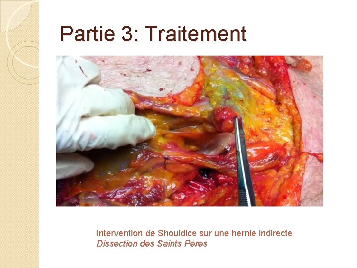 Partie 3: Traitement Intervention de Shouldice sur une hernie indirecte Dissection des Saints Pères