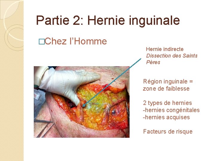 Partie 2: Hernie inguinale �Chez l’Homme Hernie indirecte Dissection des Saints Pères Région inguinale
