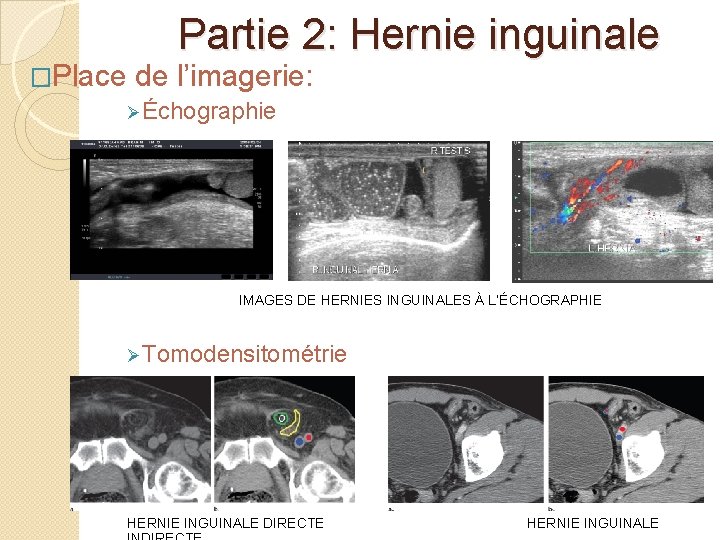Partie 2: Hernie inguinale �Place de l’imagerie: ØÉchographie IMAGES DE HERNIES INGUINALES À L’ÉCHOGRAPHIE