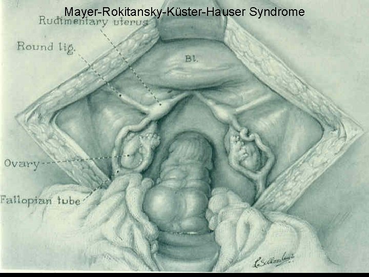 Mayer-Rokitansky-Küster-Hauser Syndrome 