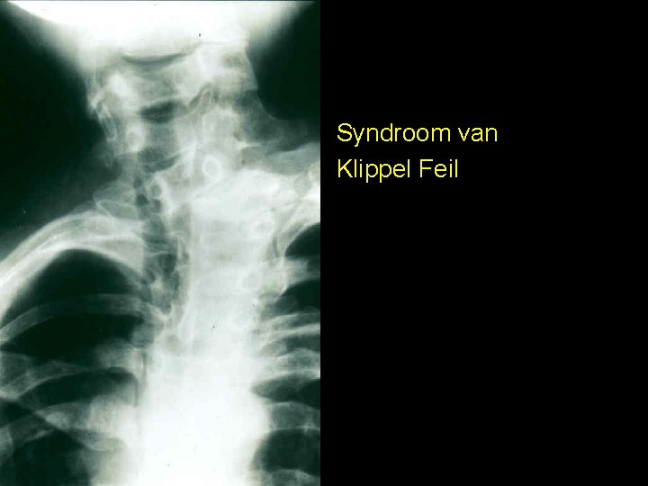 Syndroom van Klippel Feil 