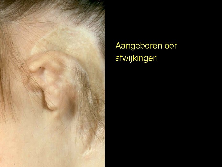 Aangeboren oor afwijkingen 