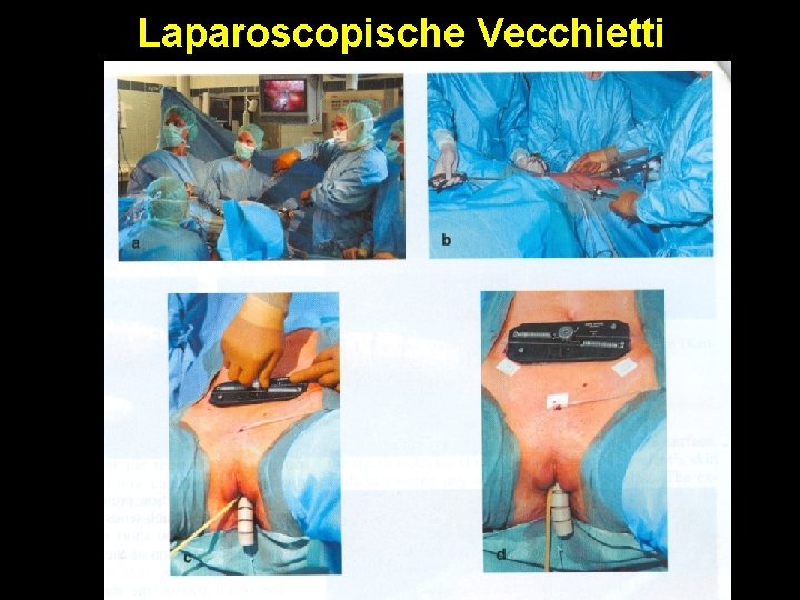 Laparoscopische Vecchietti 