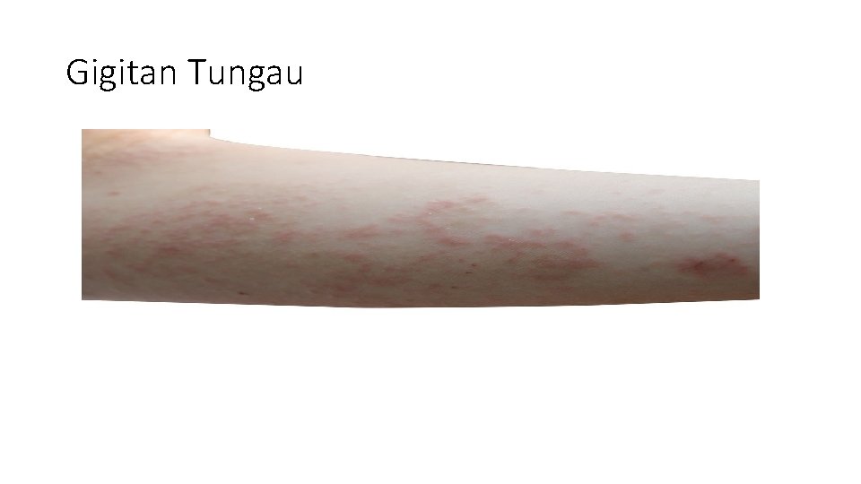 Gigitan Tungau 