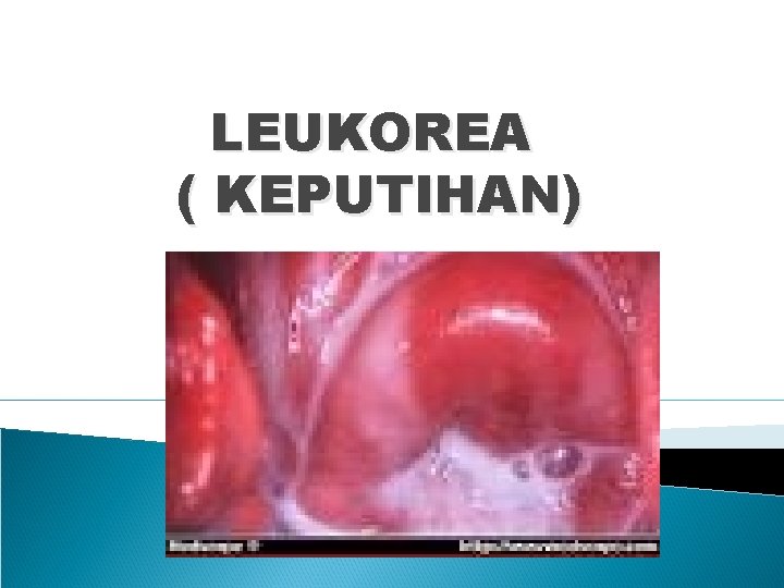 LEUKOREA ( KEPUTIHAN) 