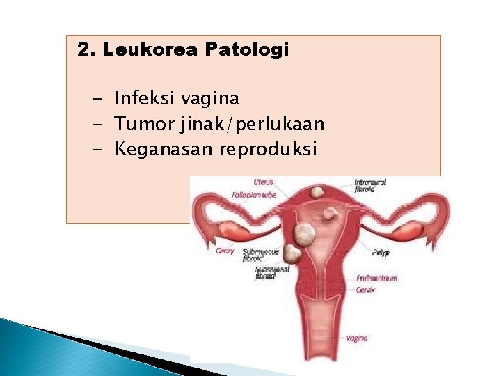 2. Leukorea Patologi - Infeksi vagina - Tumor jinak/perlukaan - Keganasan reproduksi 