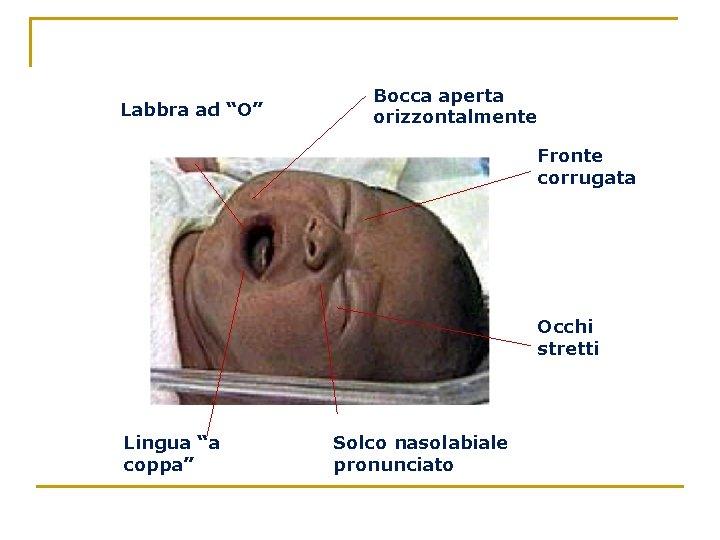Labbra ad “O” Bocca aperta orizzontalmente Fronte corrugata Occhi stretti Lingua “a coppa” Solco