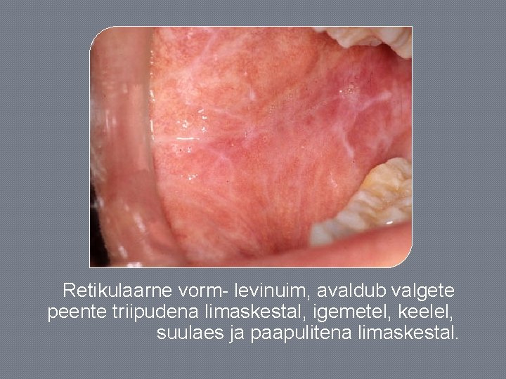 Retikulaarne vorm- levinuim, avaldub valgete peente triipudena limaskestal, igemetel, keelel, suulaes ja paapulitena limaskestal.