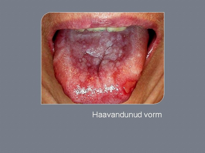 Haavandunud vorm 