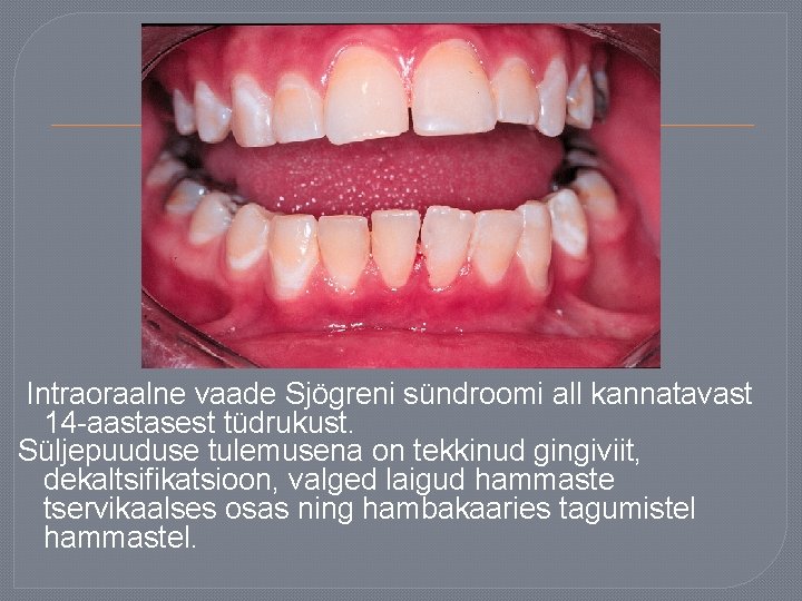 Intraoraalne vaade Sjögreni sündroomi all kannatavast 14 -aastasest tüdrukust. Süljepuuduse tulemusena on tekkinud gingiviit,