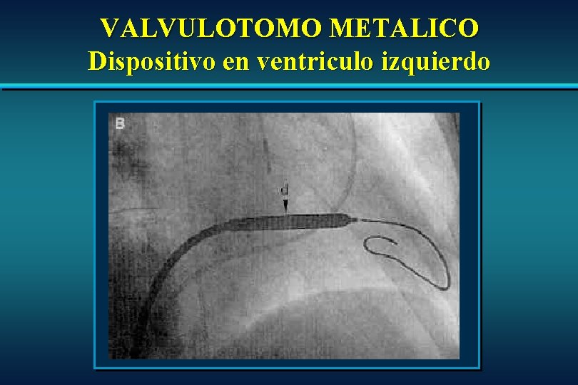 VALVULOTOMO METALICO Dispositivo en ventriculo izquierdo VALVULOTOMO METALICO Dispositivo en ventriculo izquierdo