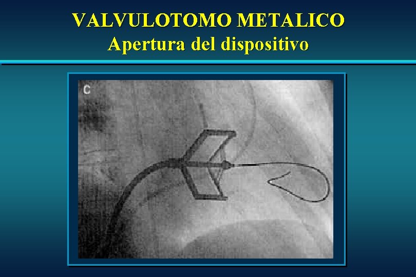 VALVULOTOMO METALICO Apertura del dispositivo VALVULOTOMO METALICO Apertura del dispositivo