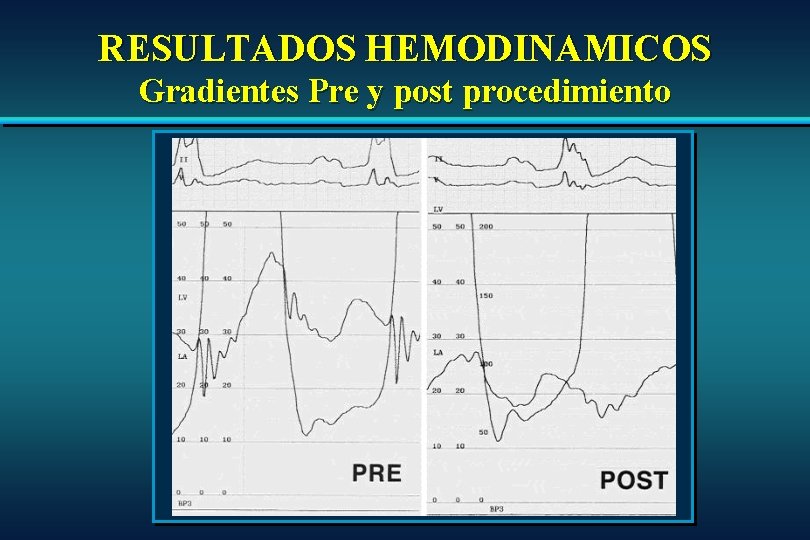 RESULTADOS HEMODINAMICOS Gradientes Pre y post procedimiento RESULTADOS HEMODINAMICOS Gradientes Pre y post procedimiento