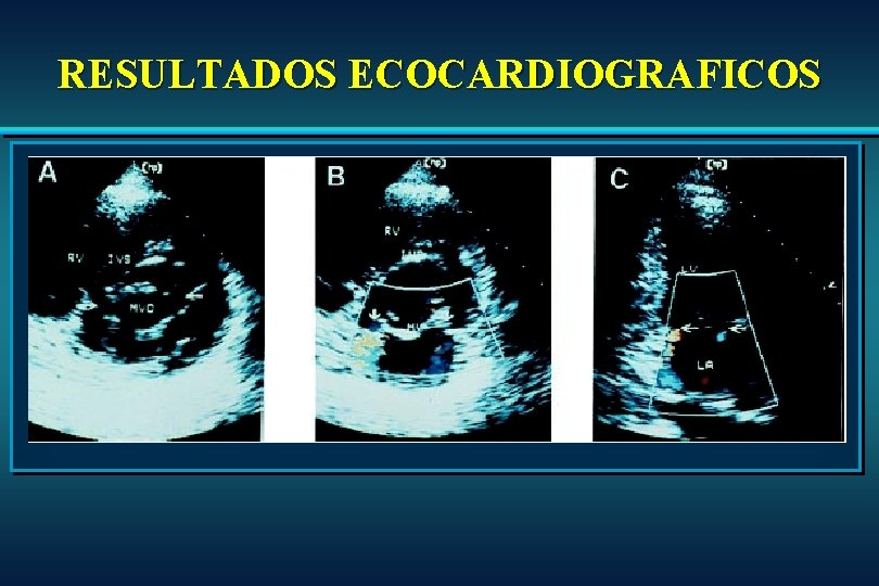RESULTADOS ECOCARDIOGRAFICOS RESULTADOS ECOCARDIOGRAFICOS