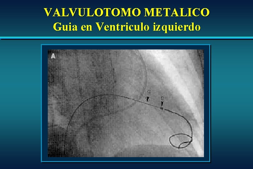 VALVULOTOMO METALICO Guia en Ventriculo izquierdo VALVULOTOMO METALICO Guia en Ventriculo izquierdo
