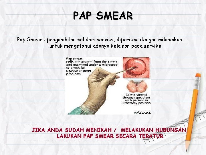 PAP SMEAR Pap Smear : pengambilan sel dari serviks, diperiksa dengan mikroskop untuk mengetahui