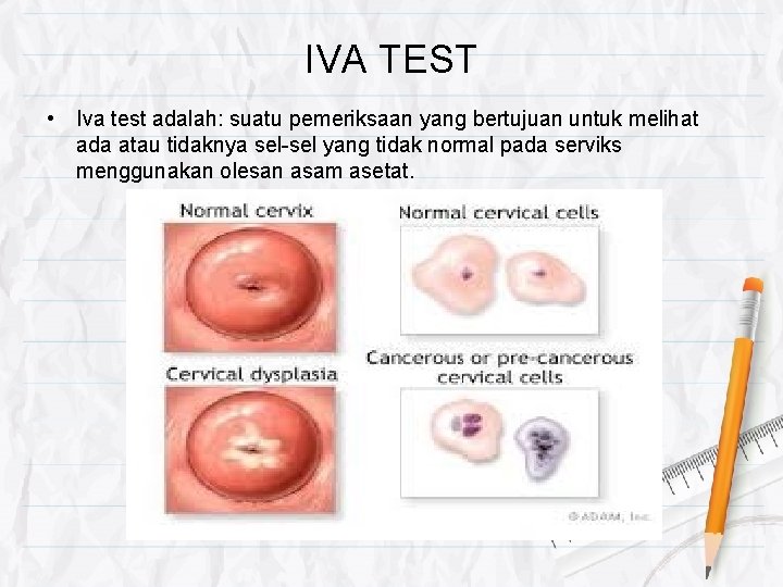 IVA TEST • Iva test adalah: suatu pemeriksaan yang bertujuan untuk melihat ada atau