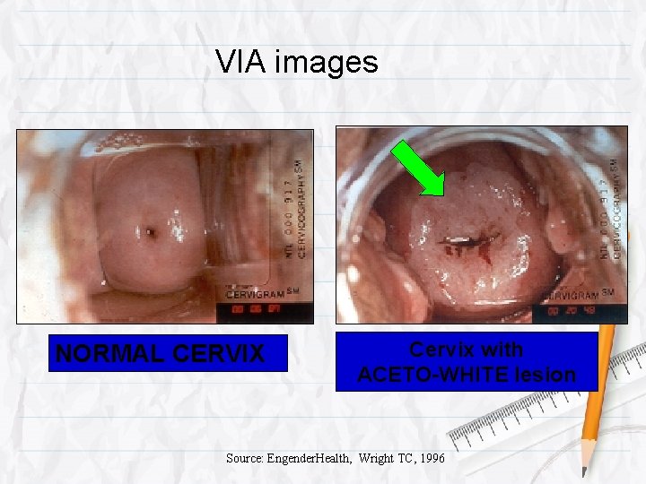 VIA images NORMAL CERVIX Cervix with ACETO-WHITE lesion Source: Engender. Health, Wright TC, 1996