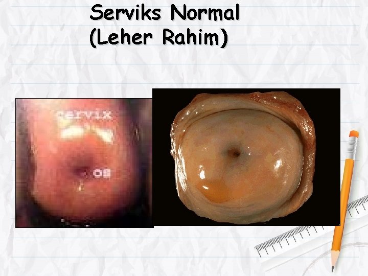 Serviks Normal (Leher Rahim) 