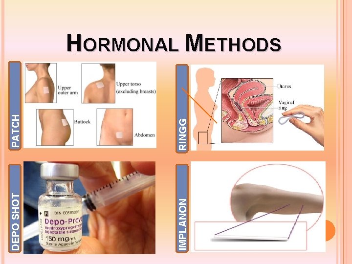 PATCH RINGG DEPO SHOT IMPLANON HORMONAL METHODS 