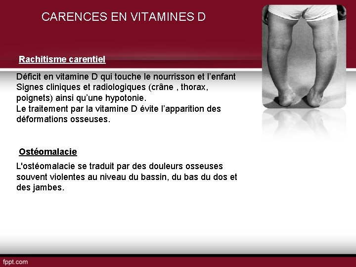 CARENCES EN VITAMINES D Rachitisme carentiel Déficit en vitamine D qui touche le nourrisson