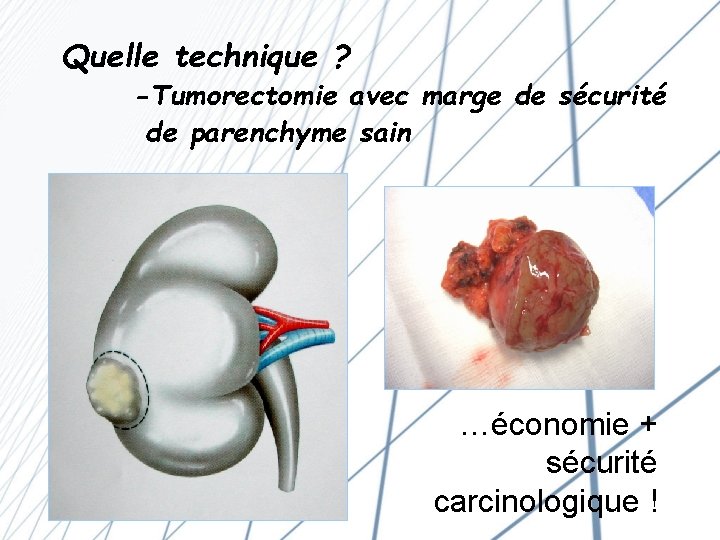 Quelle technique ? -Tumorectomie avec marge de sécurité de parenchyme sain …économie + sécurité