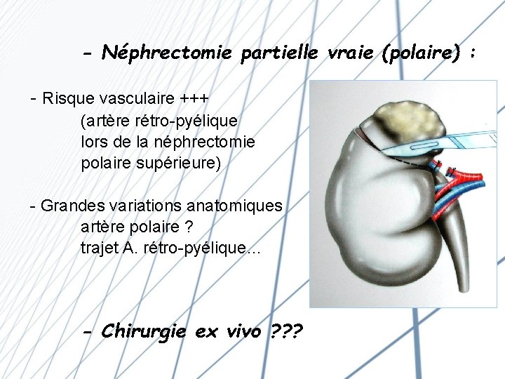 - Néphrectomie partielle vraie (polaire) : - Risque vasculaire +++ (artère rétro-pyélique lors de