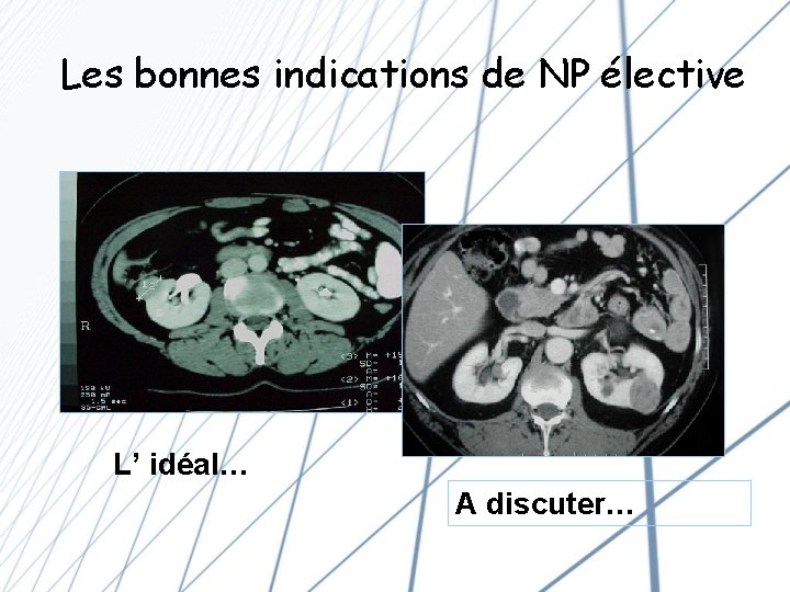 Les bonnes indications de NP élective L’ idéal… A discuter… 