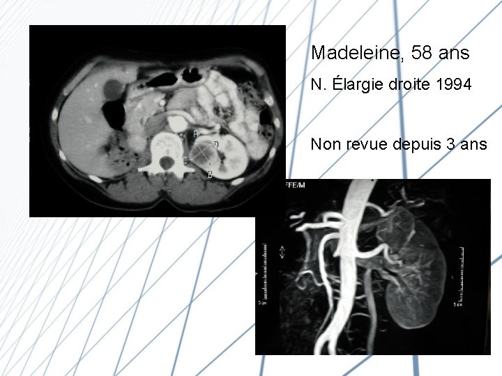 Madeleine, 58 ans N. Élargie droite 1994 Non revue depuis 3 ans 