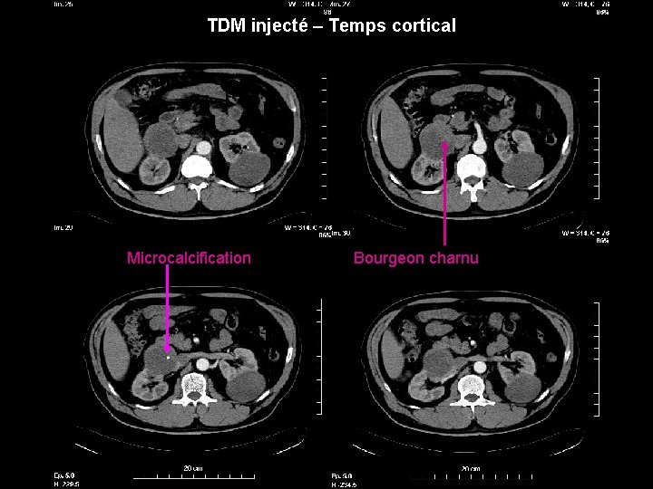 TDM injecté – Temps cortical Microcalcification Bourgeon charnu 