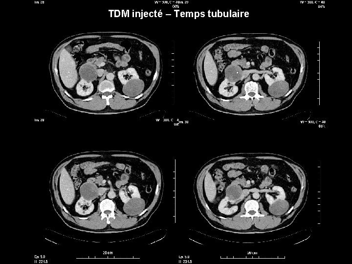 TDM injecté – Temps tubulaire 