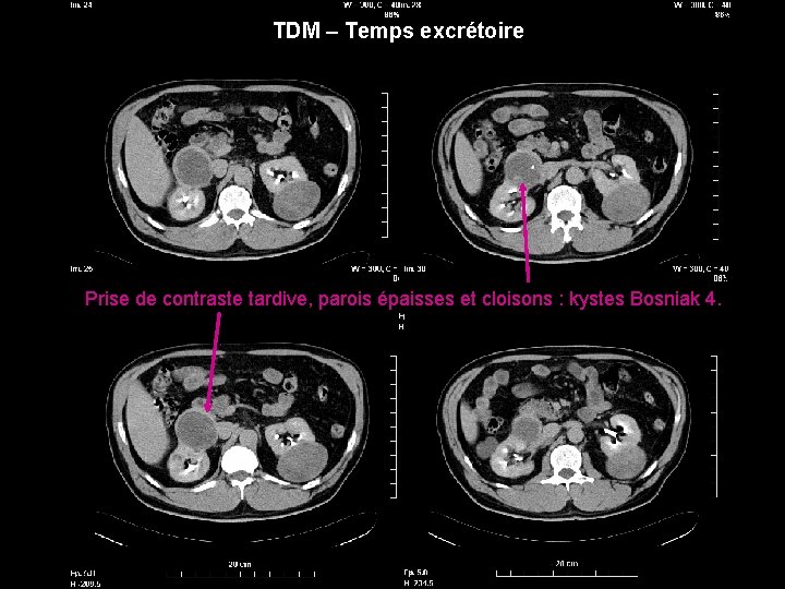 TDM – Temps excrétoire Prise de contraste tardive, parois épaisses et cloisons : kystes