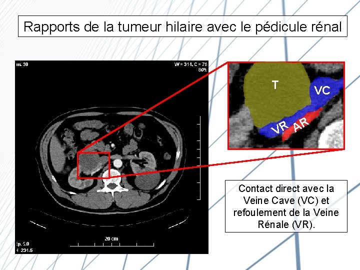 Rapports de la tumeur hilaire avec le pédicule rénal T VC R VR A