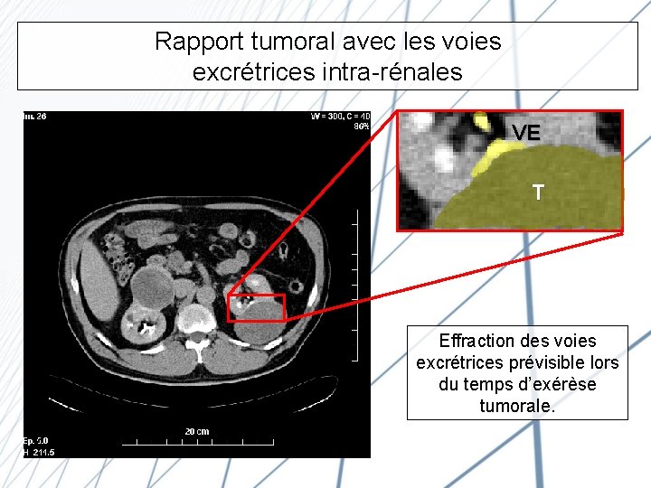 Rapport tumoral avec les voies excrétrices intra-rénales VE T Effraction des voies excrétrices prévisible