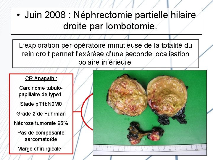  • Juin 2008 : Néphrectomie partielle hilaire droite par lombotomie. L’exploration per-opératoire minutieuse