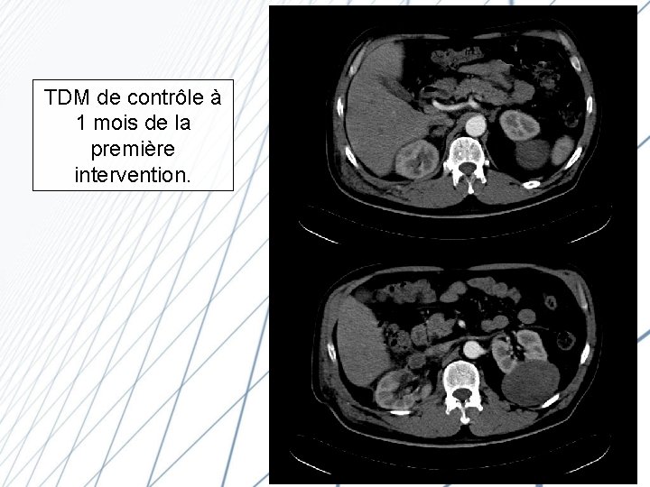 TDM de contrôle à 1 mois de la première intervention. 