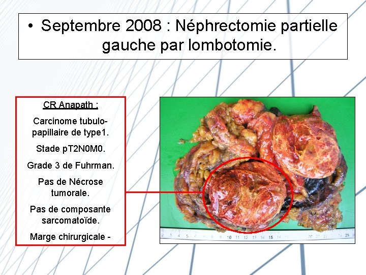  • Septembre 2008 : Néphrectomie partielle gauche par lombotomie. CR Anapath : Carcinome