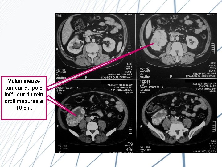 Volumineuse tumeur du pôle inférieur du rein droit mesurée à 10 cm. 