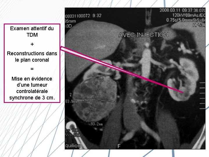 Examen attentif du TDM + Reconstructions dans le plan coronal = Mise en évidence