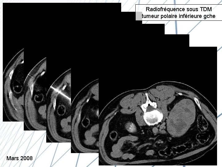 Radiofréquence sous TDM tumeur polaire inférieure gche Mars 2008 