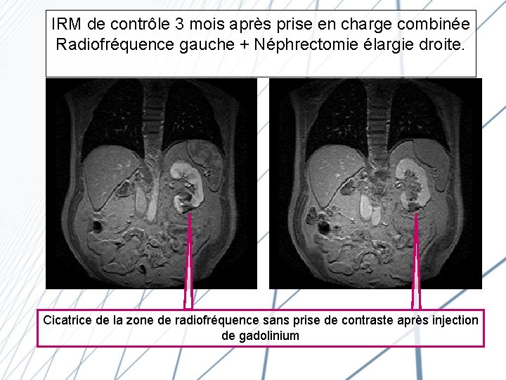 IRM de contrôle 3 mois après prise en charge combinée Radiofréquence gauche + Néphrectomie