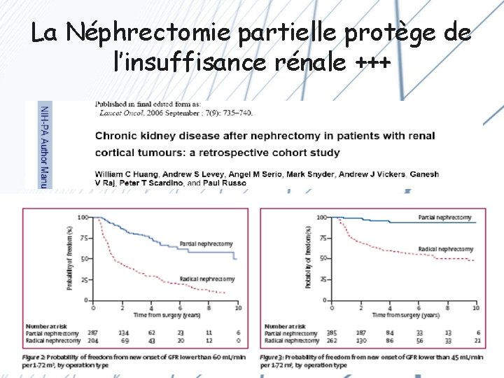 La Néphrectomie partielle protège de l’insuffisance rénale +++ 